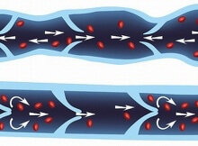 varicose veins